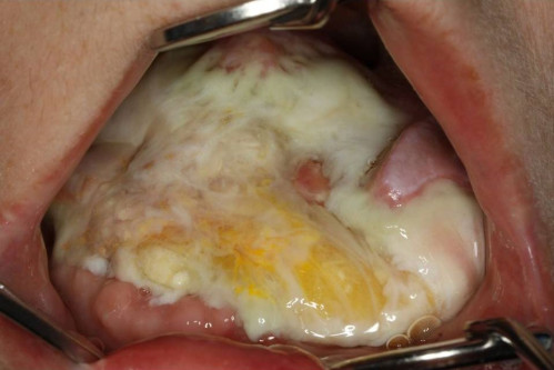 Makroskopie - intraoral postoperativ