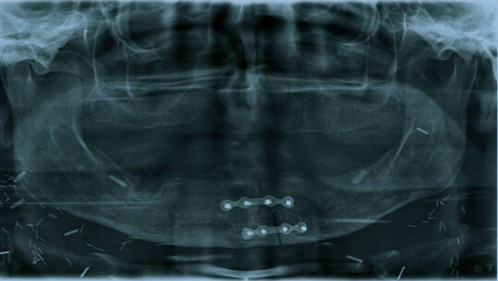 Bildgebung - OPAN postoperativ