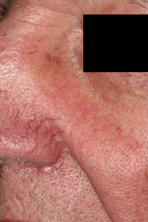 Makroskopie - Gesicht frontal präoperativ