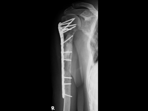 Bildgebung - Röntgen Schulter a.p. postoperativ