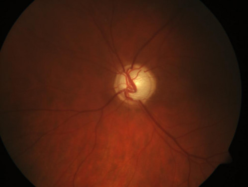 Auge drückt_1
