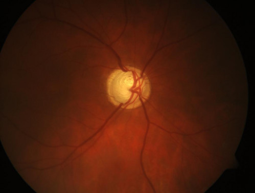 Auge drückt_2
