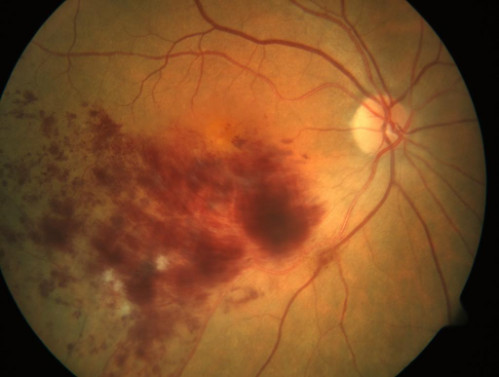 Auge auf dem Schlauch_1