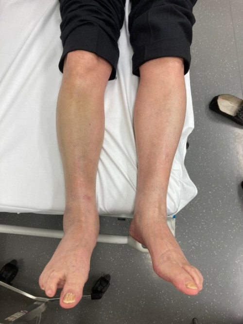 Inspektionsbefund 1 Untere Extremitäten