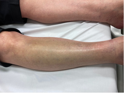 Inspektionsbefund 2 Unterschenkel rechts