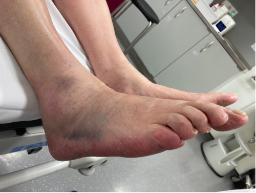 Inspektionsbefund 3 Fuß rechts