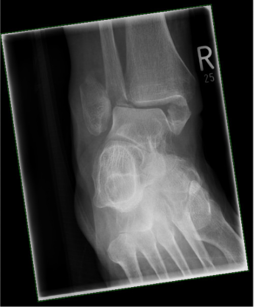 Röntgen OSG rechts a.p.