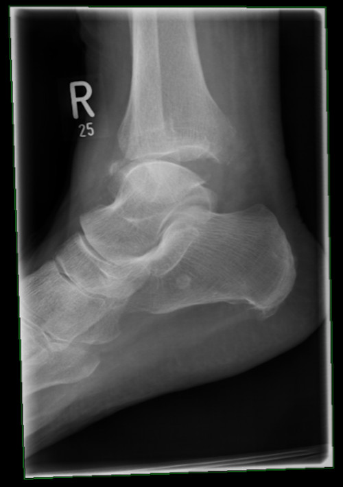 Röntgen OSG rechts seitlich