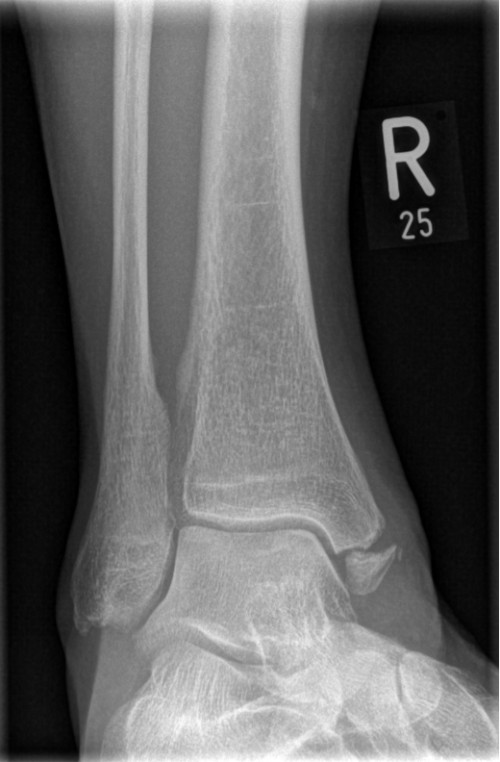 Röntgen OSG rechts a.p.