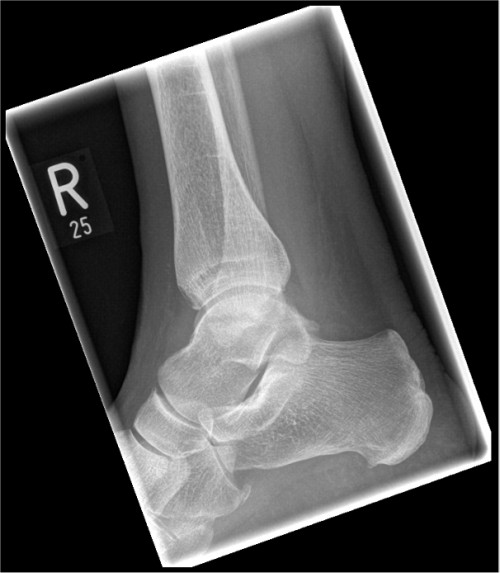 Röntgen OSG rechts lateral