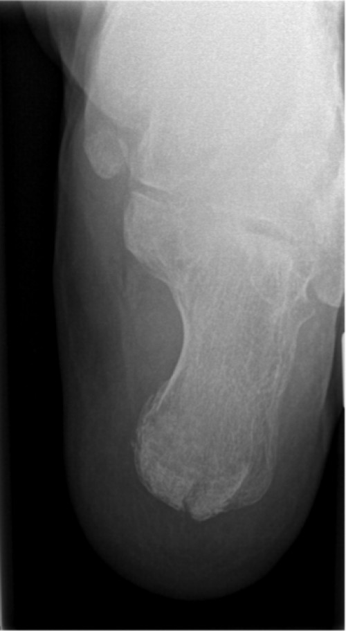 Röntgen Calcaneus links axial