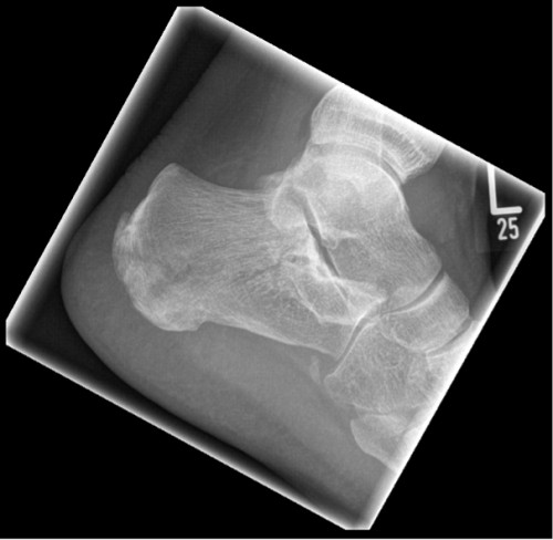 Röntgen Calcaneus links lateral