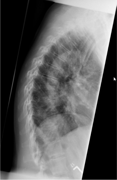 Röntgen BWS lateral