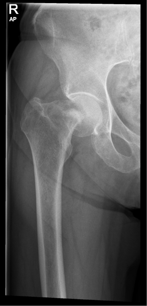 Röntgen Oberschenkel rechts a.p.