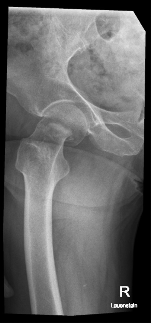 Röntgen Oberschenkel rechts Lauensteinaufnahme (axial)