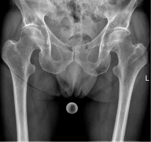 Alte Röntgenaufnahme (vor 3 Wochen) - Becken tief