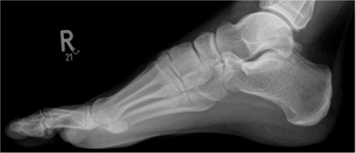Röntgen Fuß rechts seitlich