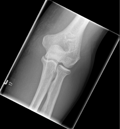 Röntgen Ellenbogen links a.p.