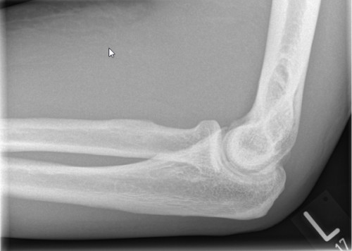 Röntgen Ellenbogen links seitlich