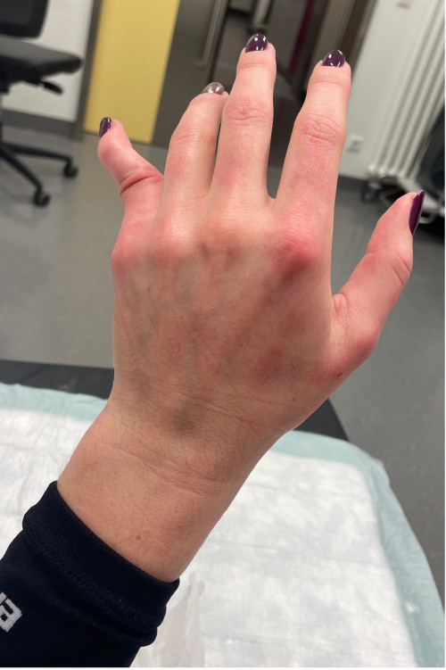 Inspektionsbefund Hand links