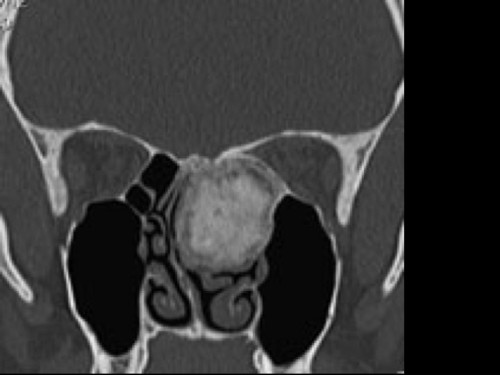 Bildgebung - CT koronar