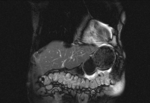 Bildgebung - koronar