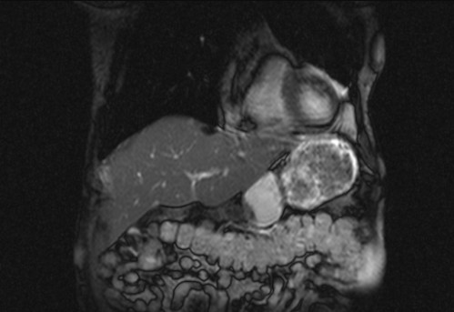 Bildgebung - koronar