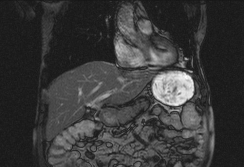 Bildgebung - koronar