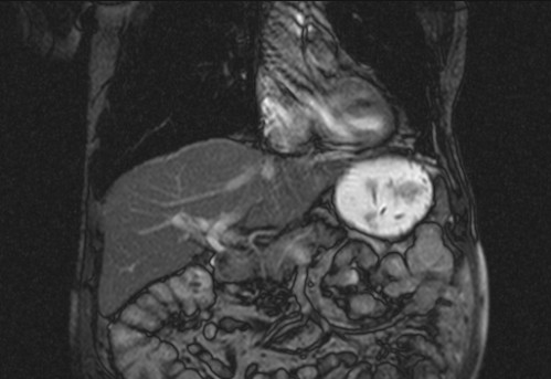 Bildgebung - koronar