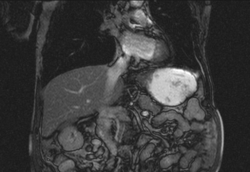 Bildgebung - koronar