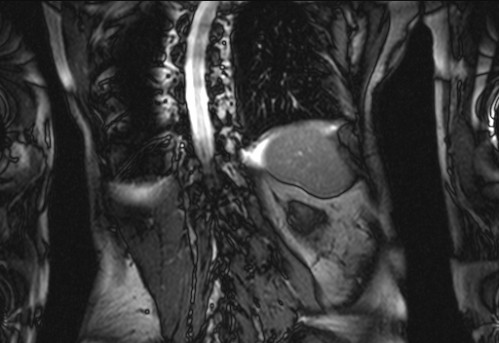 Bildgebung - koronar