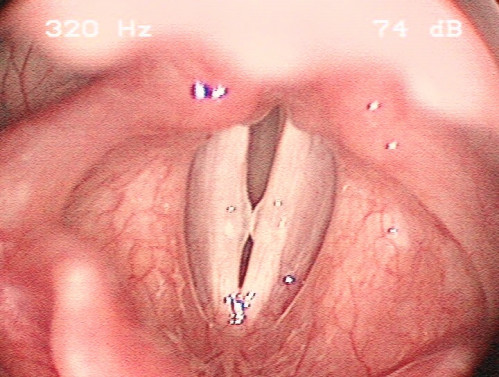 Makroskopie - Lupenlaryngoskopie (90° Optik, transoral) Phonation