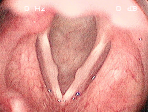 Makroskopie - Lupenlaryngoskopie (90° Optik, transoral) Respiration