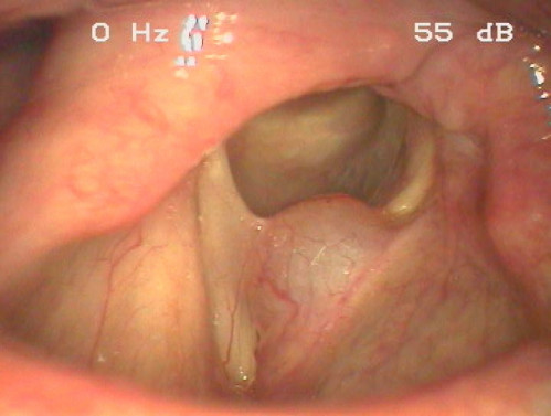 Makroskopie - Lupenlaryngoskopie (90° Optik, transoral) Respiration