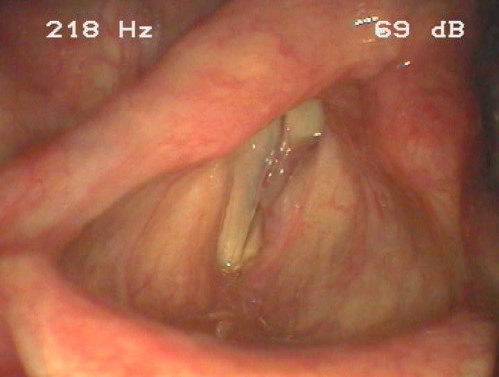 Makroskopie - Lupenlaryngoskopie (90° Optik, transoral) Phonation
