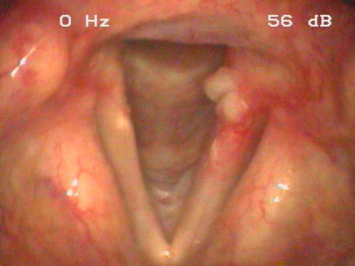 Makroskopie - Lupenlaryngoskopische (90°-Optik, transoral) Respiration