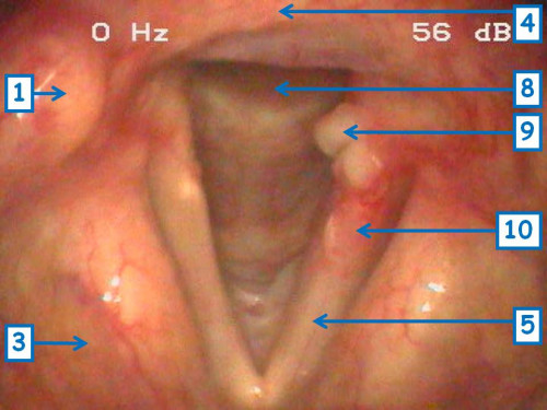 Makroskopie - Lupenlaryngoskopische (90°-Optik, transoral) Respiration