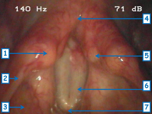 Makroskopie - Lupenlaryngoskopische (90°-Optik, transoral) Phonation
