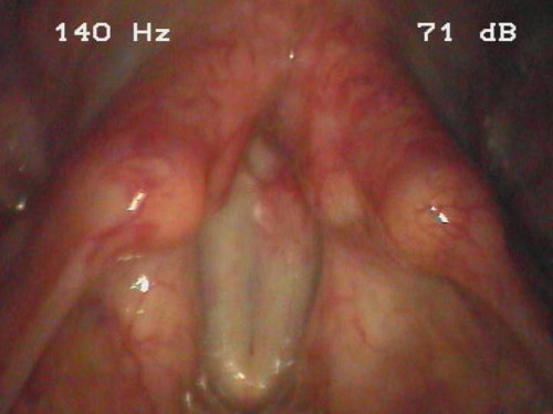 Makroskopie - Lupenlaryngoskopische (90°-Optik, transoral) Phonation