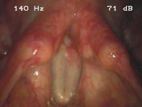 Makroskopie - Lupenlaryngoskopie (90° Optik) Phonation