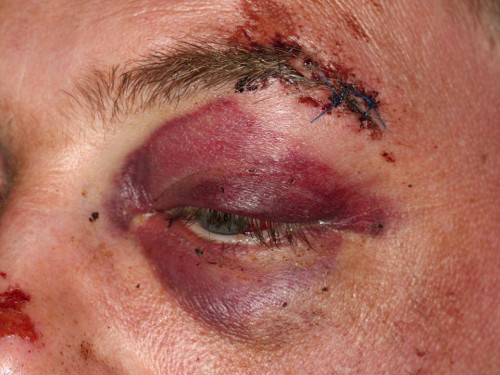 Makroskopie - Monokelhämatom